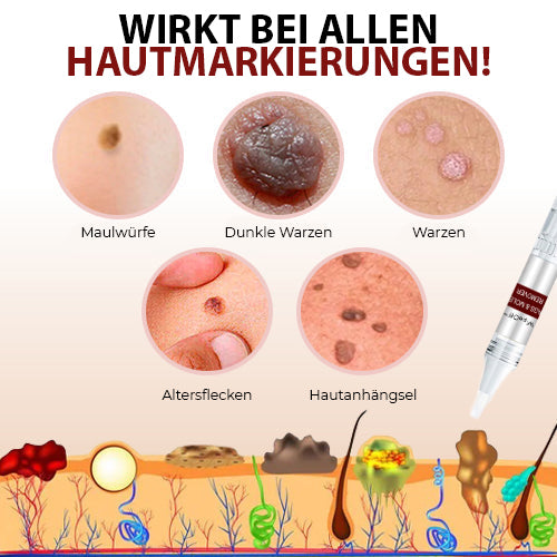DermaPure Huidlabels Verwijderaar – Pijnloze & Veilige Oplossing voor Een Egale Huid 5