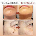 DermaPure Huidlabels Verwijderaar – Pijnloze & Veilige Oplossing voor Een Egale Huid 6