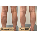 Lymfomat | Acupunctuurpunten-therapie voor een betere doorbloeding 6